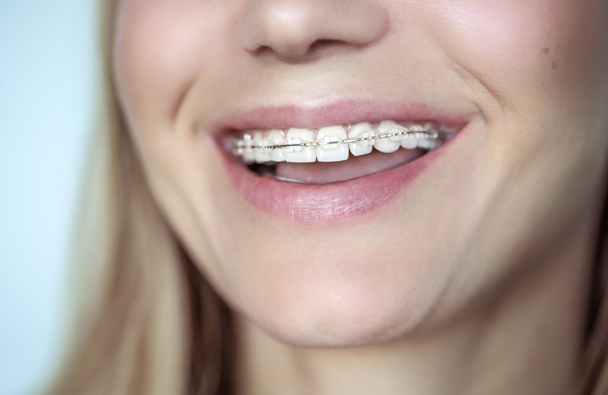 Ceramic Braces, 3M Clarity Advanced Braces