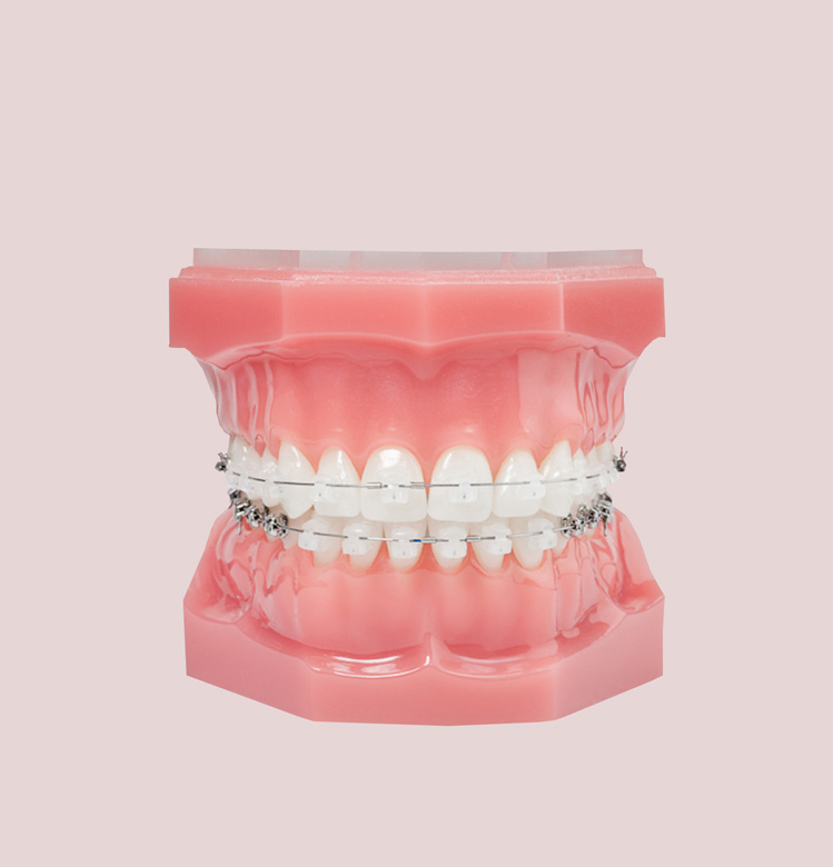 Ceramic Braces, 3M Clarity Advanced Braces