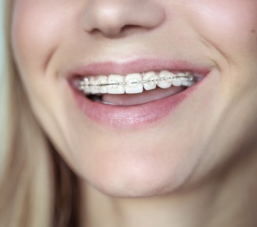 Ceramic braces